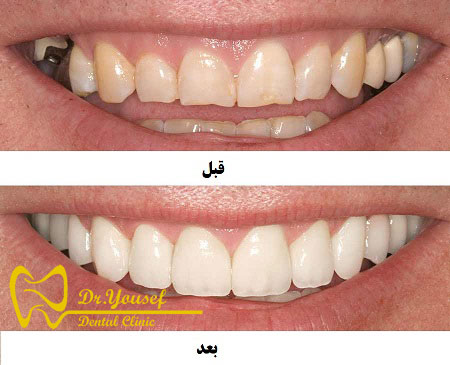 لبخند زیبا با انجام خدمات اصلاح طرح لبخند