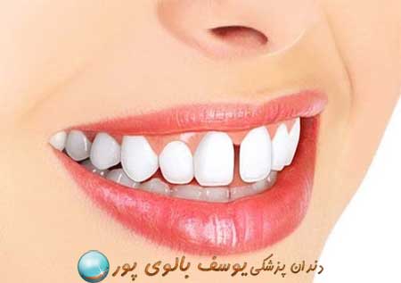 رفع فاصله بین دندان