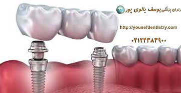 ایمپلنت دندان در مطب دکتر بالوی پور