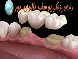 بریج کردن دندان