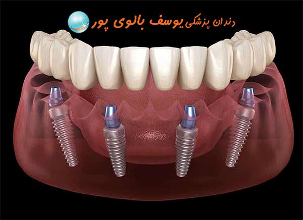 ایمپلنت دندان