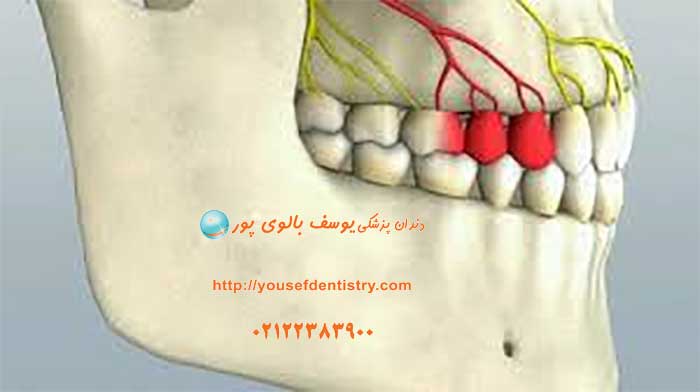 التهاب لثه