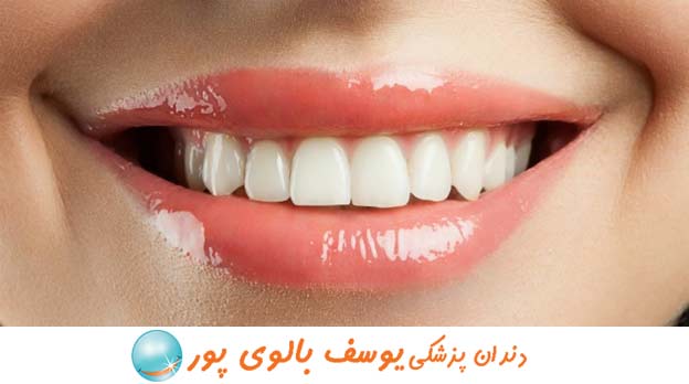 لمینت دندان