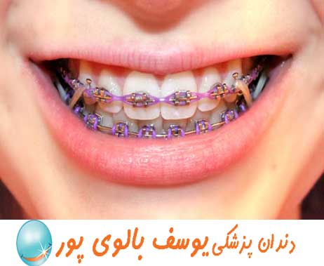 ارتودنسی دندان