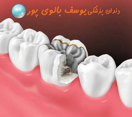 ایمپلنت دندان