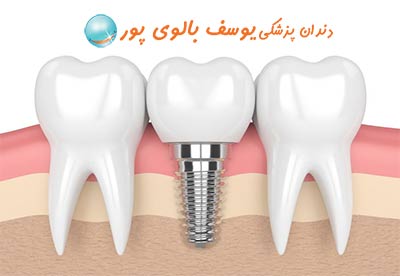 ایمپلنت دندان