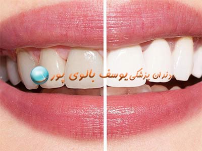 بلیچینگ دندان