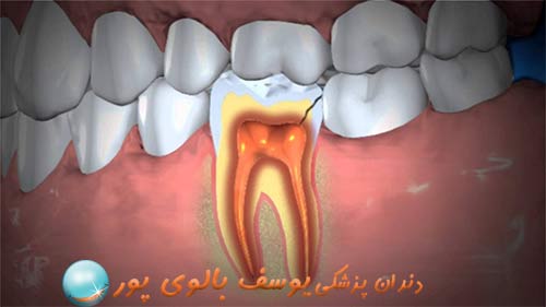  در مطب دکتر بالوی پور لمینت دندان