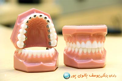 ارتودنسی و کامپوزیت دندان