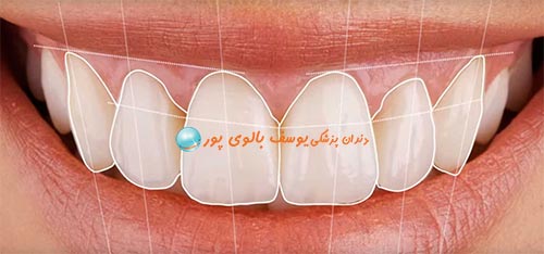 طراحی لبخند زیبا در کلینیک دکتر بالوی پور
