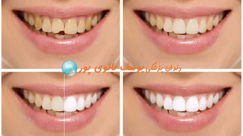 لمینت دندان در کلینیک دکتر بالوی پور