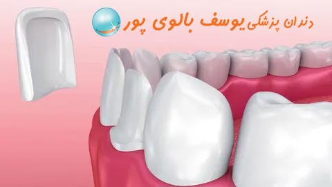 لمینت دندان یا کامپوزیت 