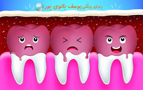 درمان پوسیدگی دندان
