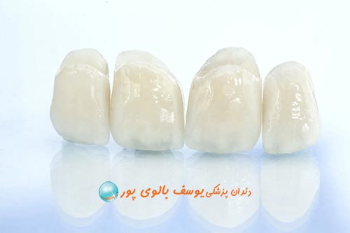 روکش دندان
