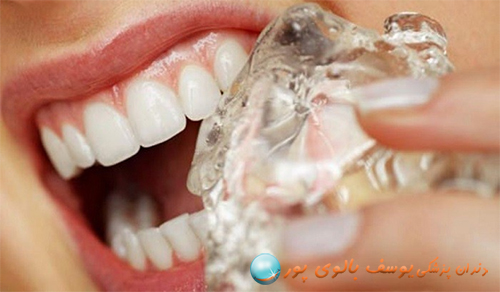جویدن یخ  باعث شکستن و از بین رفتن قسمتی از مینای دندان می‌گردد.