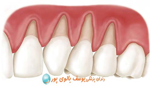 عمل لیفت لثه