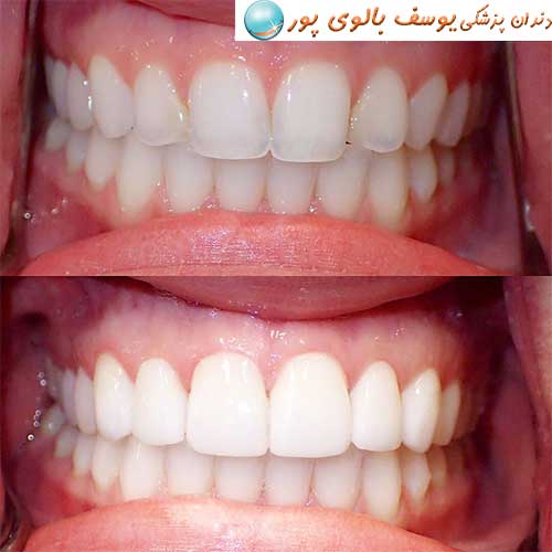 کامپوزیت دندان