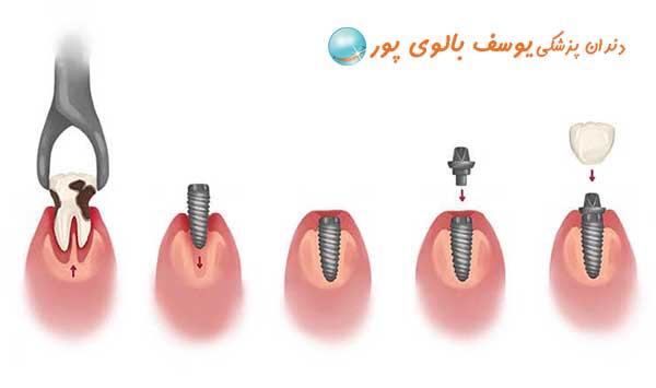 ایمپلنت دندان در سعادت آباد