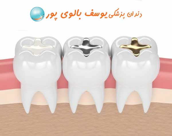 کامپوزیت دندان