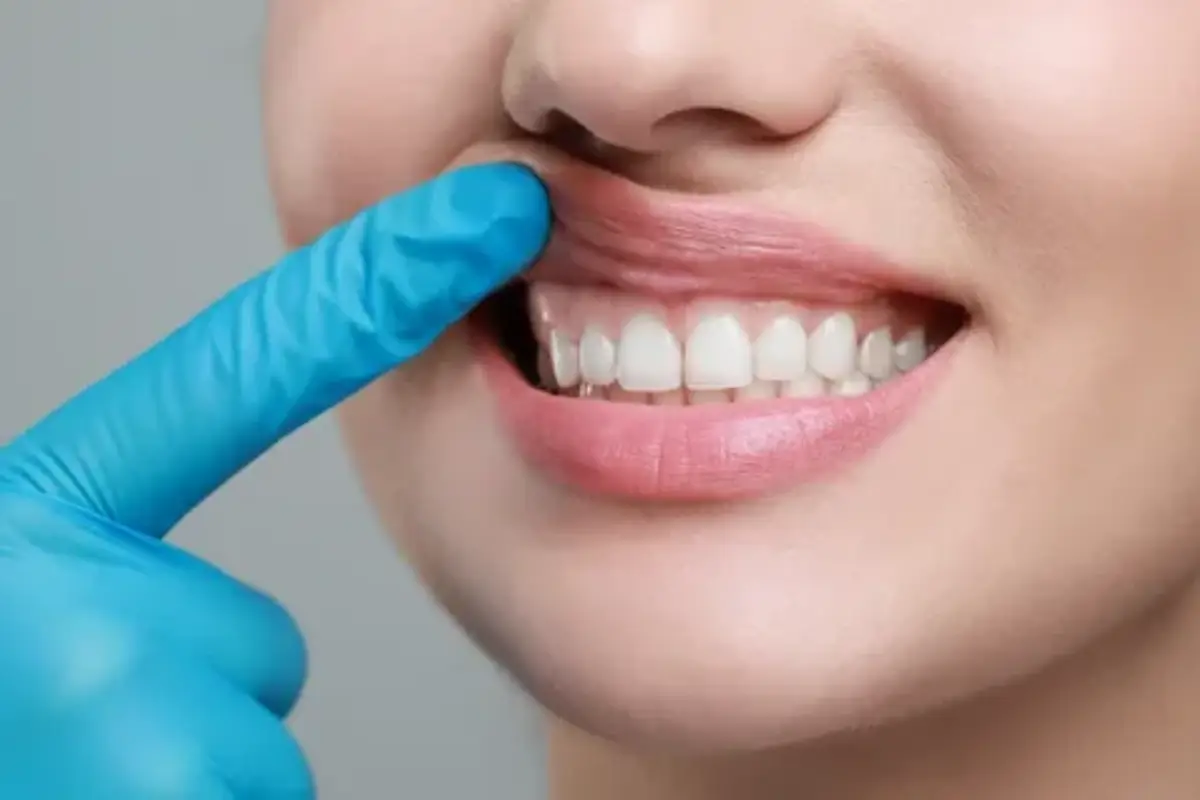 Leukoplakia2