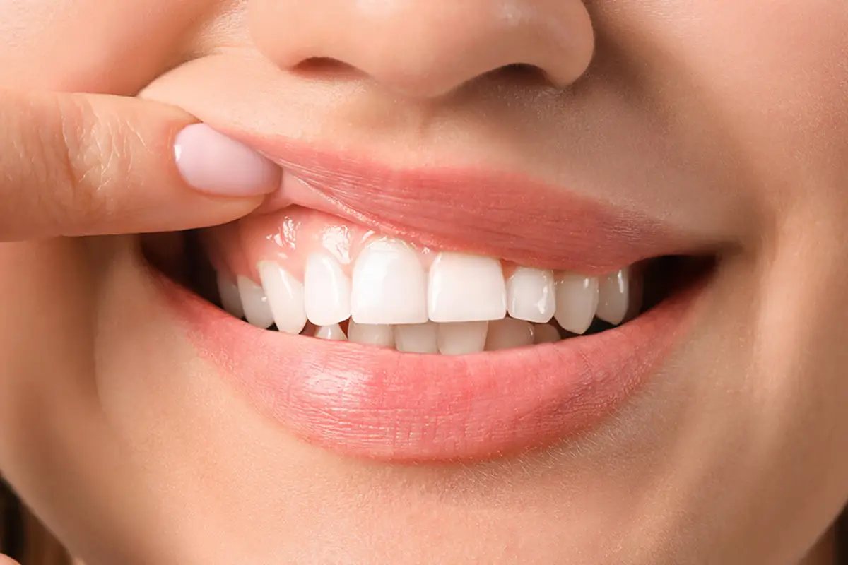 Leukoplakia 1