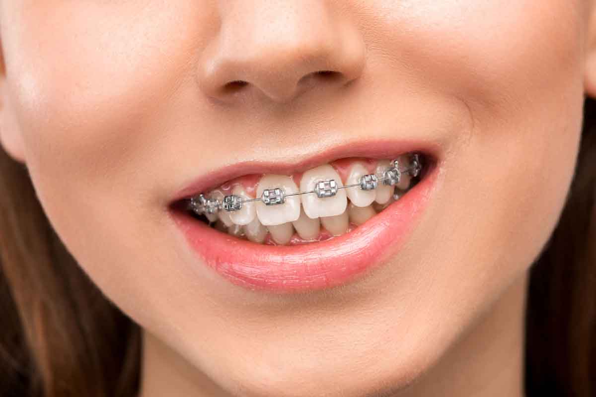 ارتودنسی تا چند سالگی جواب میده