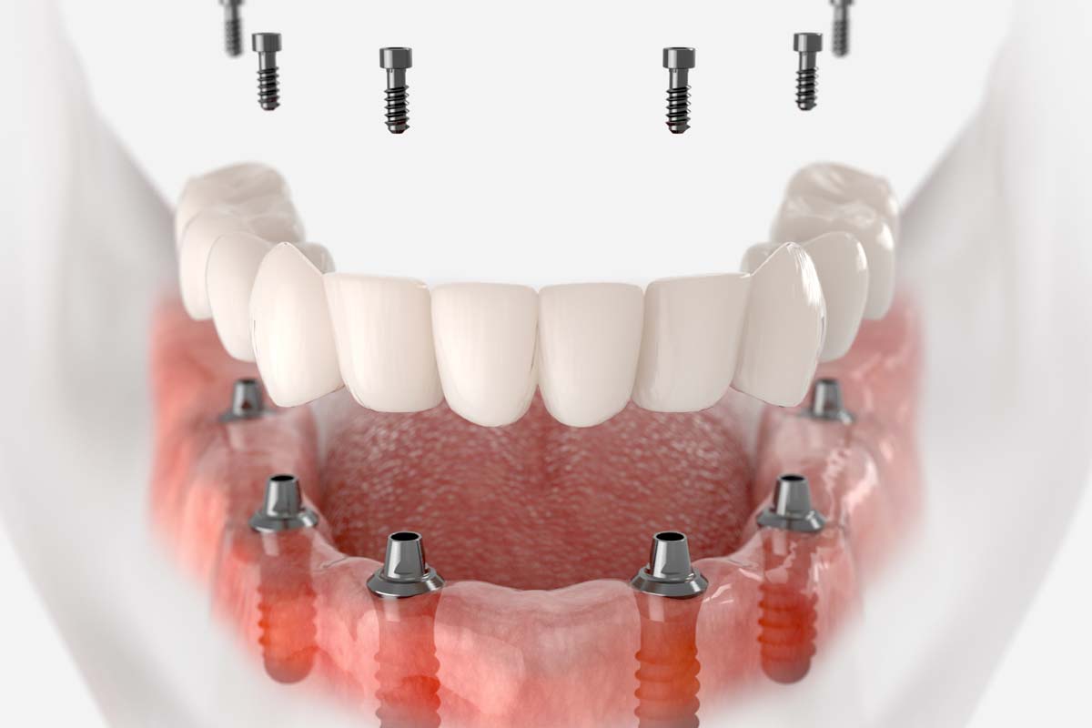 دندان مصنوعی بر پایه ایمپلنت 