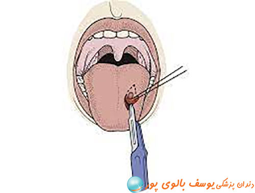 biopsy