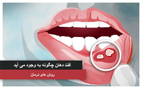 آفت دهان