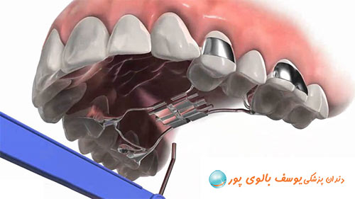 پالاتال اکسپندر