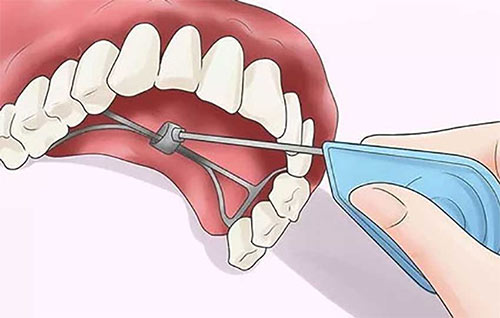 پالاتال اکسپندر یا وسیع کننده کام