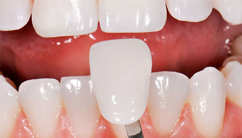 tooth laminate