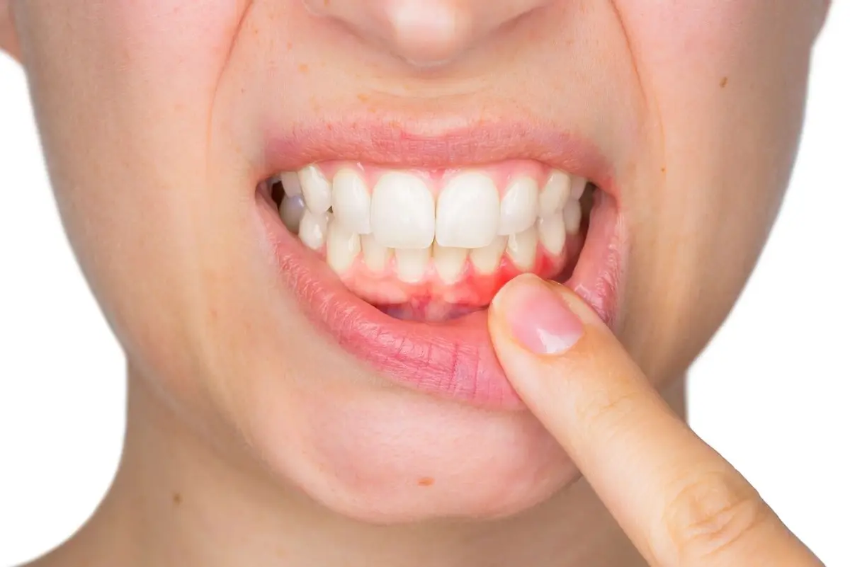 tooth_abscess.webp
